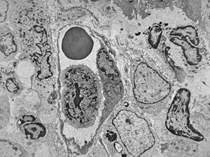 jejunum … celiakia … infiltration in lamina propria jejunum … celiakia … infiltration in lamina propria